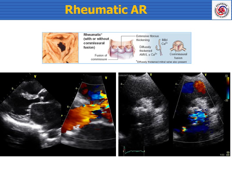 Rheumatic AR